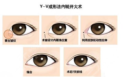 开眼角疤痕增生解决办法