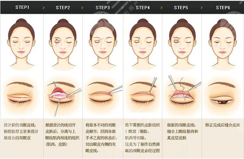 双眼皮全切过程,让大家在做手术之前可以深入了解,并做好相应准备!