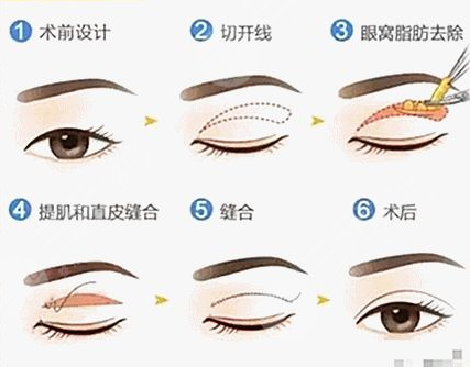 双眼皮全切过程,让大家在做手术之前可以深入了解,并做好相应准备!