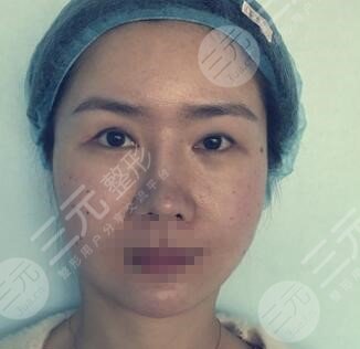 大庆油田医院双眼皮手术案例
