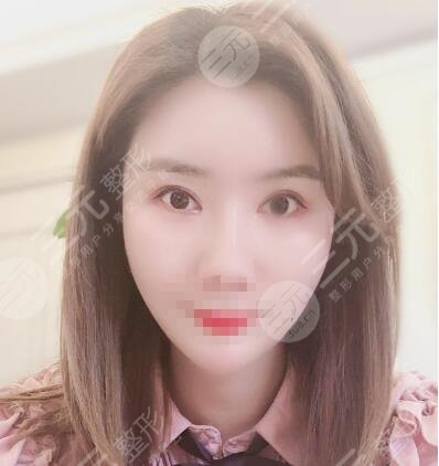 大庆油田医院双眼皮手术案例