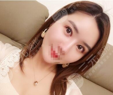 大庆油田医院双眼皮手术案例