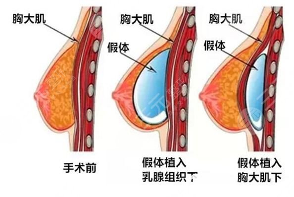 乳房整形有没有可以维持终生的呢?身材凹凸有致会增加女性的个人魅力