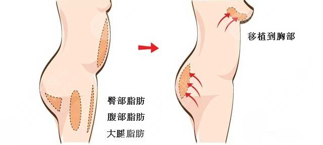 乳房整形有没有可以维持终生的呢?身材凹凸有致会增加女性的个人魅力