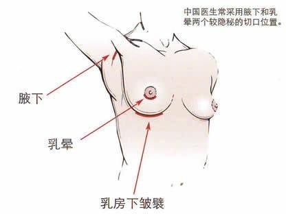 乳房整形有没有可以维持终生的呢?身材凹凸有致会增加女性的个人魅力