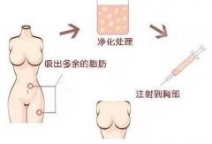 乳房整形有没有可以维持终生的呢?身材凹凸有致会增加女性的个人魅力