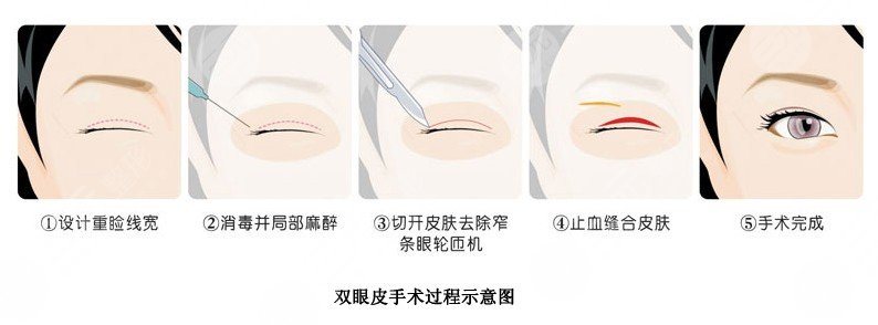 双眼皮肿消了还会变窄吗？一起来看看这个问题是怎么回事吧