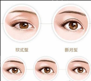 双眼皮肿消了还会变窄吗？一起来看看这个问题是怎么回事吧