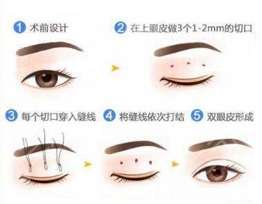 双眼皮肿消了还会变窄吗？一起来看看这个问题是怎么回事吧