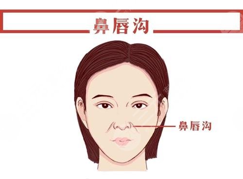 鼻唇沟填充