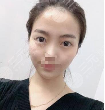 兰大二院整形外科双眼皮案例
