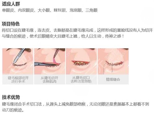保持多久,纳米微创,双眼皮,