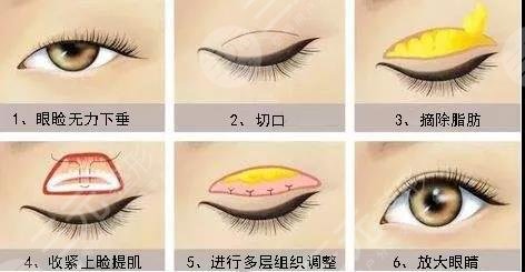 眼皮下垂手术费用是多少？千万别再让眼皮下垂遮住你的美丽啦