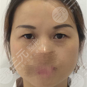 眼皮下垂手术费用是多少？千万别再让眼皮下垂遮住你的美丽啦