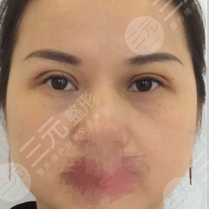 眼皮下垂手术费用是多少？千万别再让眼皮下垂遮住你的美丽啦