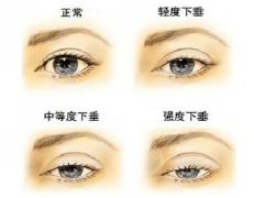 眼皮下垂手术费用是多少？千万别再让ta遮住你的美丽啦！
