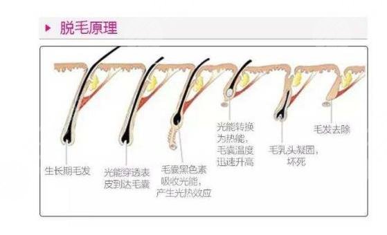 冰点脱毛原理