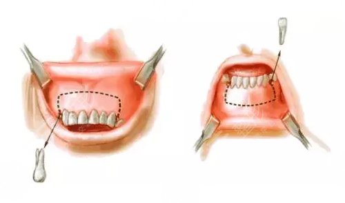 龅牙怎么矫正？如何解决龅牙这个问题，成为了他们的重中之重