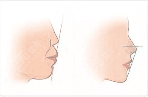 龅牙怎么矫正?如何解决龅牙这个问题,成为了他们的重中之重