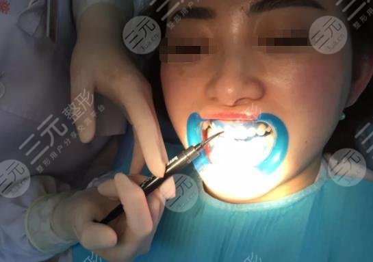 辽阳八一口腔医院牙齿冷光美白分享