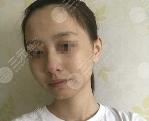 关于上海九院隆鼻手术