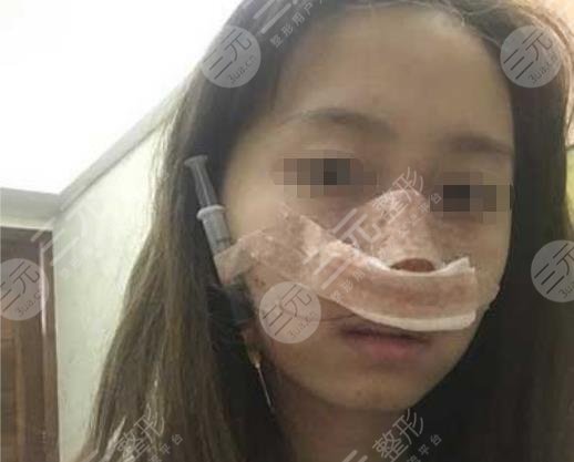 关于上海九院隆鼻手术