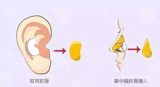 自体软骨隆鼻