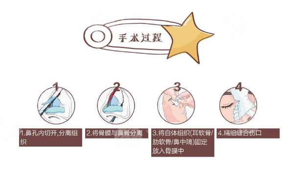 自体软骨隆鼻手术