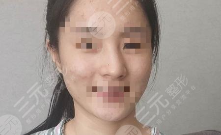 歪鼻整形矫正案例
