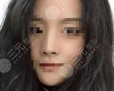 歪鼻整形矫正案例