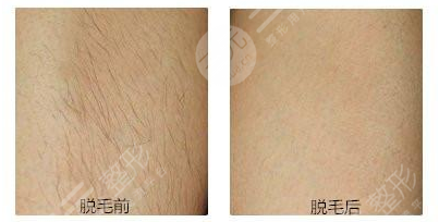 彩光长时间脱毛