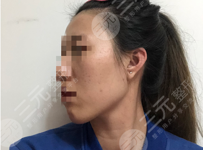 白瓷娃娃案例