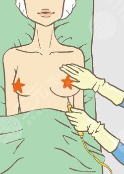 湘雅医院祁敏医生假体隆胸案例分享,让我的胸独具魅力~