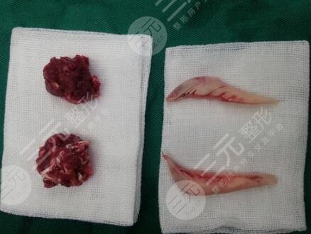 手术中损伤神经