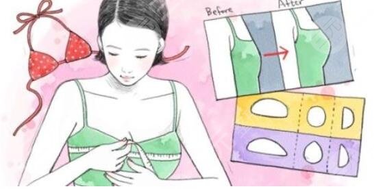 北京假体隆胸真人案例大分享，丰胸果看得见