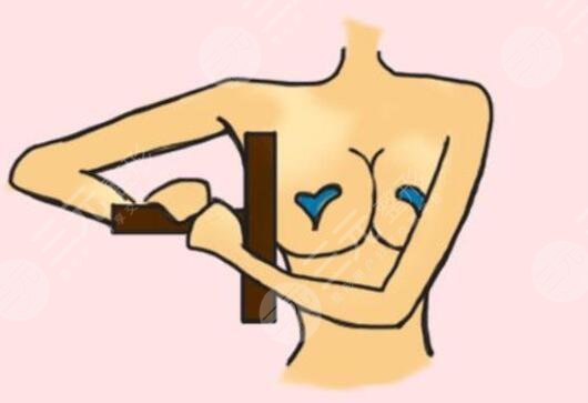 广州天姿医疗美容医院自体脂肪隆胸过程图——汪海滨医生
