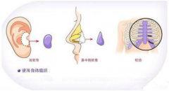 鼻整形材料有哪些？一定要选择正规、专业的医院进行鼻整形的操作！