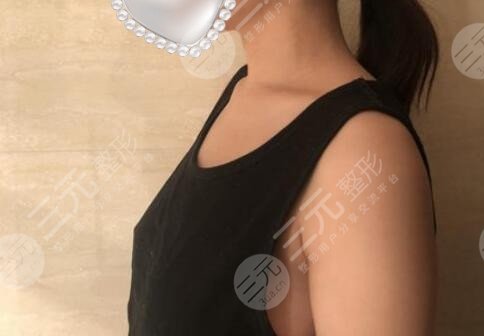 上海妙桃假体丰胸多少钱？当然所有人较在意的就是做完假体之后轮廓是否自然