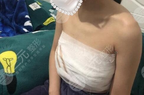 上海妙桃假体丰胸多少钱？当然所有人较在意的就是做完假体之后轮廓是否自然