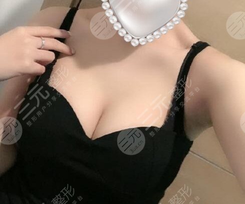 上海妙桃假体丰胸多少钱？当然所有人较在意的就是做完假体之后轮廓是否自然