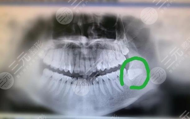 深圳南州口腔拔牙经历分享