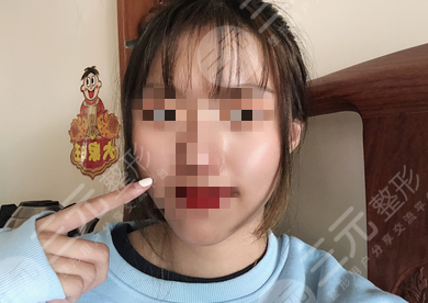 白瓷娃娃缓解后
