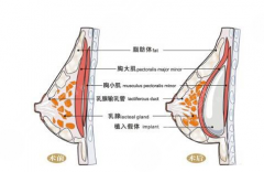 曼托假体隆胸怎么样?优点和禁忌人群