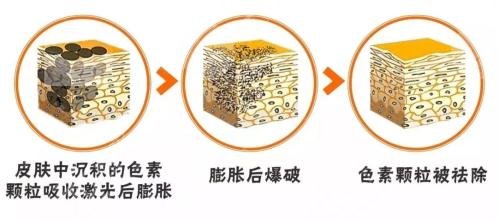 激光美容祛斑手术