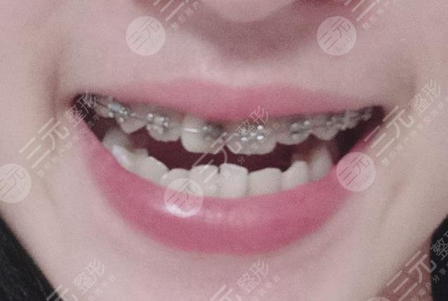 北京八大处整形医院牙齿矫正缓解分享