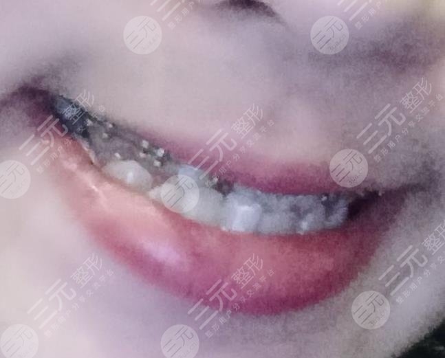 北京八大处整形医院牙齿矫正缓解分享