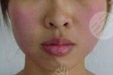 厚唇改薄术前