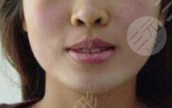 厚唇改薄术后