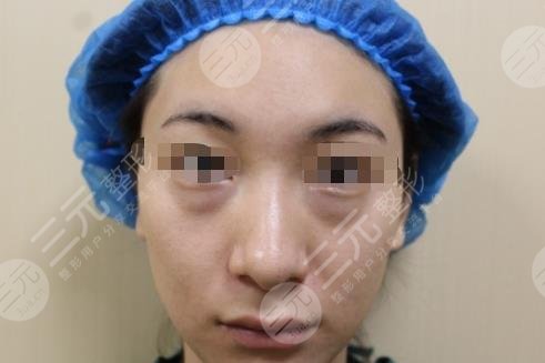 重庆西南医院眼袋手术分享