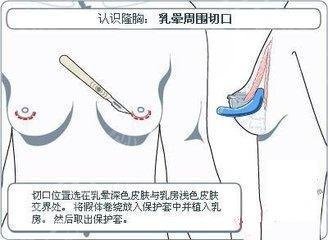 隆胸的方式